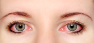eye redness